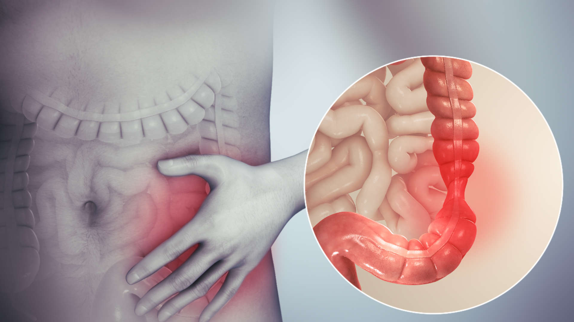 Coping with Irritable Bowel Syndrome