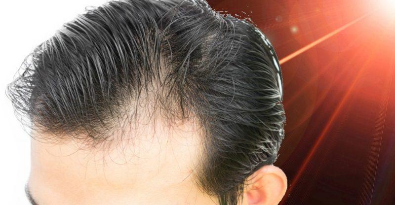 Low-Level Laser Therapy to Combat Hair Loss - Does it Really Work?