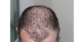 Confidence-during-hair-loss
