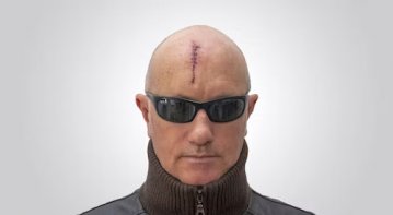 Difference Between Surgical Glue and Liquid Stitches in Wound Closure