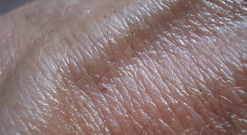 Comprehensive Guide to Identifying Skin Cancer Symptoms Early
