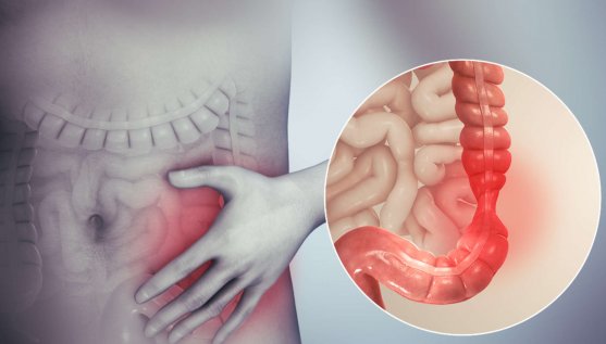 Coping with Irritable Bowel Syndrome