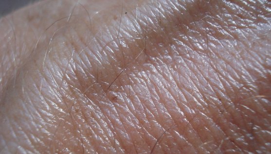 Comprehensive Guide to Identifying Skin Cancer Symptoms Early