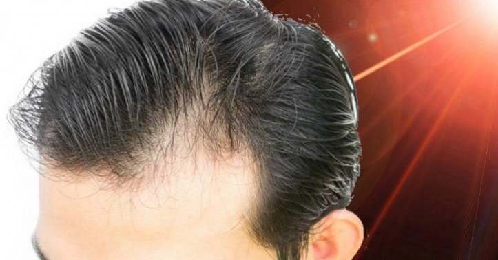 Low-Level Laser Therapy to Combat Hair Loss