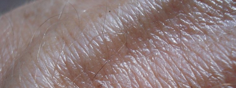 Comprehensive Guide to Identifying Skin Cancer Symptoms Early